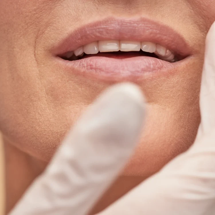 Filler labbra a Busto Arsizio